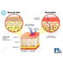 Eczema/Dermatitis - remedies in homeopathy