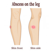 Abscess - remedies in homeopathy