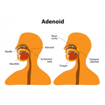 Adenoids - remedies in homeopathy