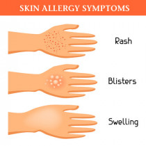 Homeopathic Remedies for Allergic Rashes