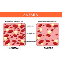 Anemia, Anaemia - remedies in homeopathy