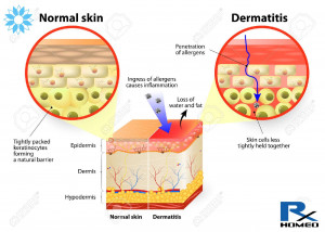 Eczema/Dermatitis - remedies in homeopathy