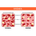 Anemia, Anaemia - remedies in homeopathy